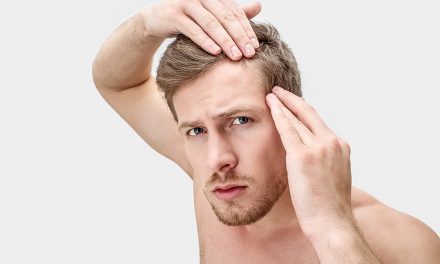 Haarausfall – ein Schicksal der Männer?