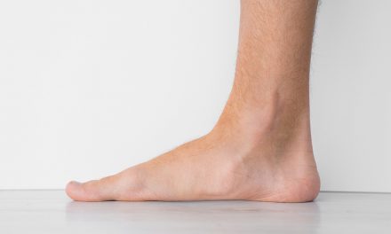 Plattfuß im Schuh – vom Sinn orthopädischer Einlagen