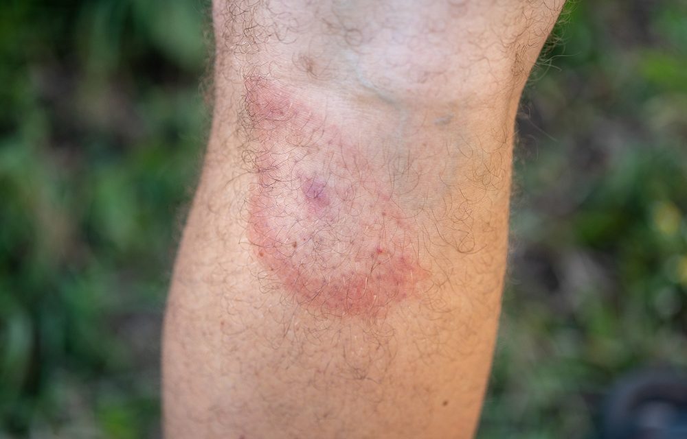 Borreliose und FSME – Informationen zum Zeckenschutz